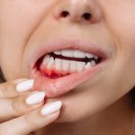 prevenir el sarro y el sangrado de encías